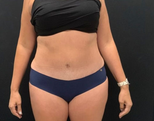 A mother of 5 in her 40s 6 months after full lipoabdominoplasty