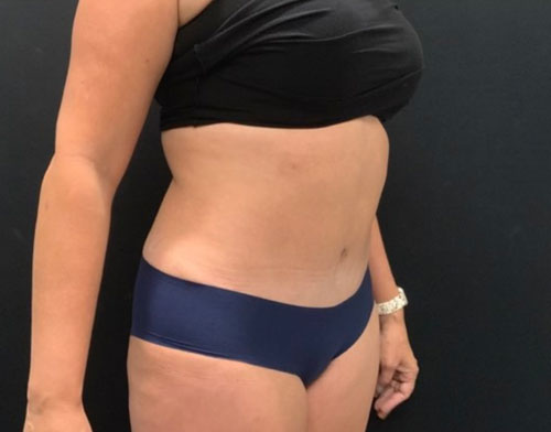 A mother of 5 in her 40s 6 months after full lipoabdominoplasty