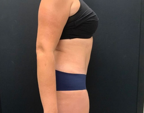 A mother of 5 in her 40s 6 months after full lipoabdominoplasty