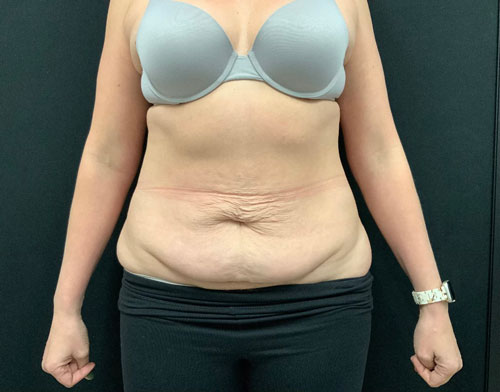 A mother of 5 in her 40s 6 months after full lipoabdominoplasty