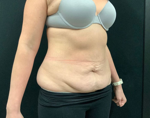 A mother of 5 in her 40s 6 months after full lipoabdominoplasty