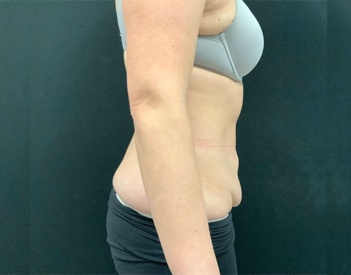 A mother of 5 in her 40s 6 months after full lipoabdominoplasty