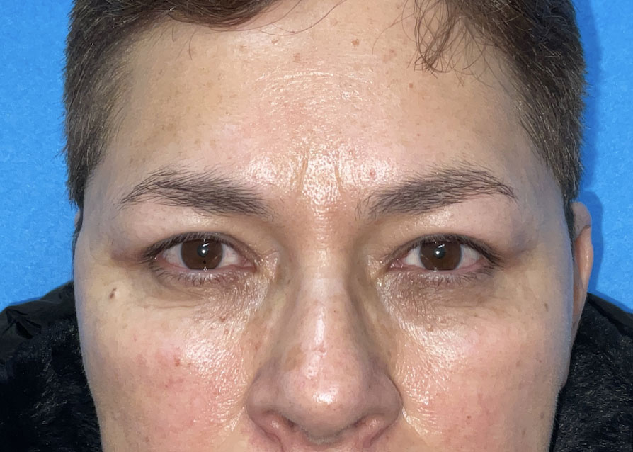 Upper blepharoplasty before and after patient front view