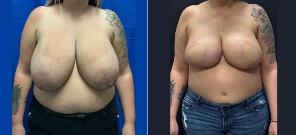 Autologous Breast Reconstruction