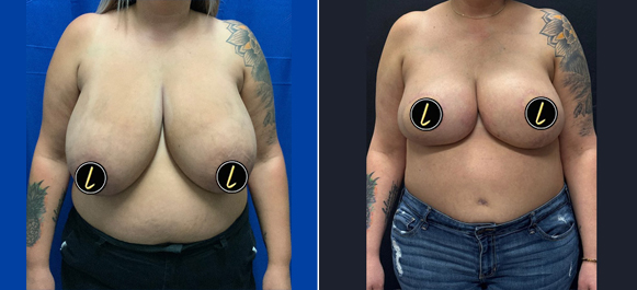 Autologous Breast Reconstruction