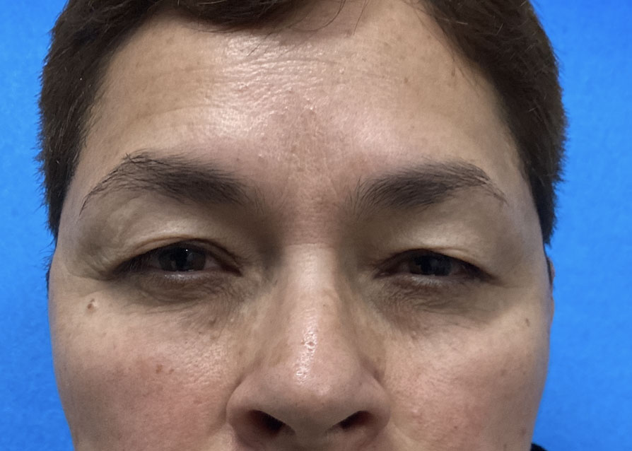 Upper blepharoplasty before and after patient front view