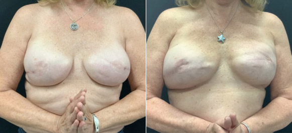 Breast-Implants