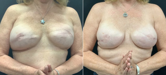 Implant Based Breast Reconstruction