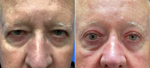 Male-Blepharoplasty