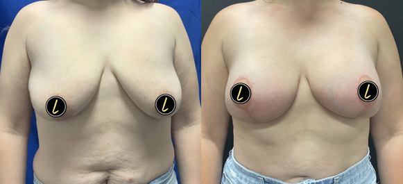 Mastopexy