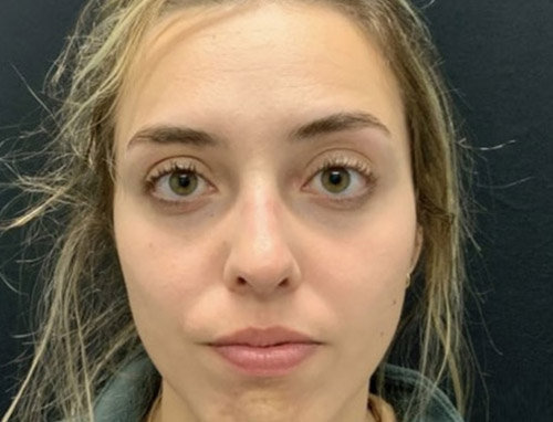 24 year old female shown 5 months after functional rhinoplasty to improve her breathing. Nasal collapse was improved with cartilage grafting and improved nasal support. Patient’s breathing significantly improved.