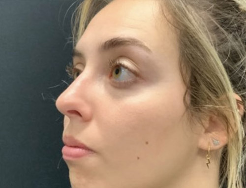 24 year old female shown 5 months after functional rhinoplasty to improve her breathing. Nasal collapse was improved with cartilage grafting and improved nasal support. Patient’s breathing significantly improved.