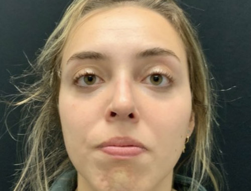 24 year old female shown 5 months after functional rhinoplasty to improve her breathing. Nasal collapse was improved with cartilage grafting and improved nasal support. Patient’s breathing significantly improved.