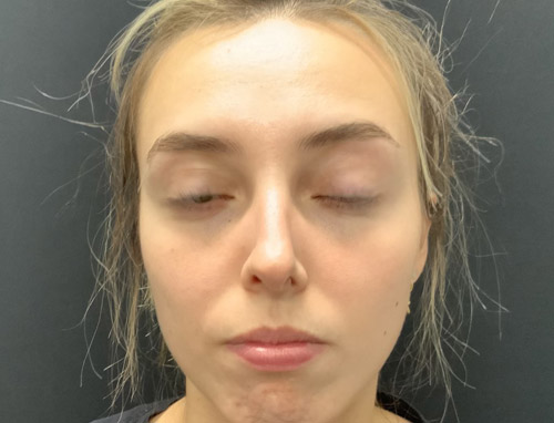 24 year old female shown 5 months after functional rhinoplasty to improve her breathing. Nasal collapse was improved with cartilage grafting and improved nasal support. Patient’s breathing significantly improved.