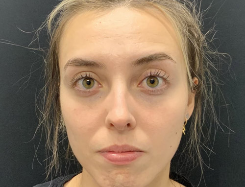 24 year old female shown 5 months after functional rhinoplasty to improve her breathing. Nasal collapse was improved with cartilage grafting and improved nasal support. Patient’s breathing significantly improved.