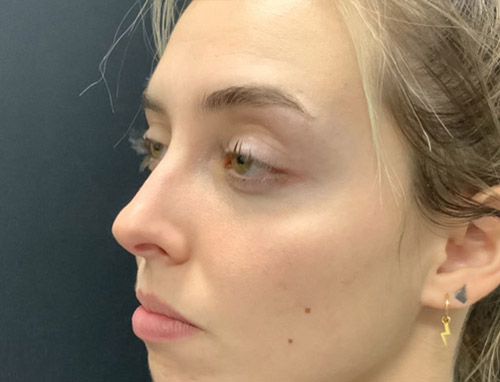 24 year old female shown 5 months after functional rhinoplasty to improve her breathing. Nasal collapse was improved with cartilage grafting and improved nasal support. Patient’s breathing significantly improved.