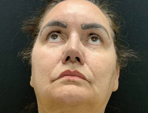 62 year old female 10 months after revision rhinoplasty after having it done years ago by another provider. Both septal and ear cartilage were used to provide structural support for her nose and improve her breathing.