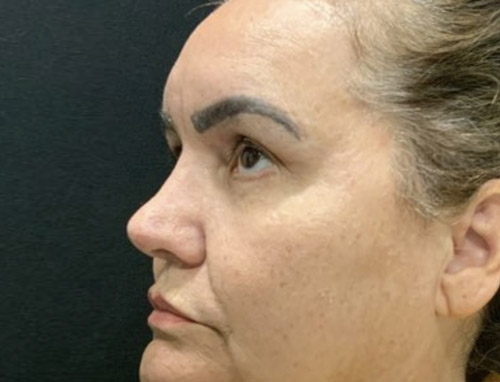 62 year old female 10 months after revision rhinoplasty after having it done years ago by another provider. Both septal and ear cartilage were used to provide structural support for her nose and improve her breathing.