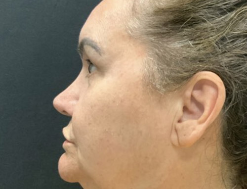 62 year old female 10 months after revision rhinoplasty after having it done years ago by another provider. Both septal and ear cartilage were used to provide structural support for her nose and improve her breathing.