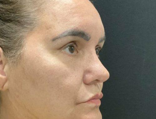 62 year old female 10 months after revision rhinoplasty after having it done years ago by another provider. Both septal and ear cartilage were used to provide structural support for her nose and improve her breathing.