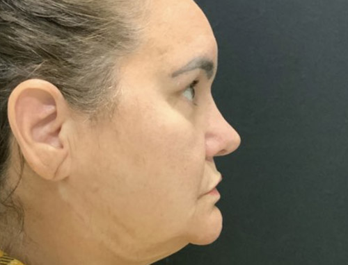 62 year old female 10 months after revision rhinoplasty after having it done years ago by another provider. Both septal and ear cartilage were used to provide structural support for her nose and improve her breathing.