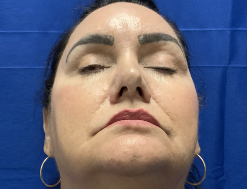 62 year old female 10 months after revision rhinoplasty after having it done years ago by another provider. Both septal and ear cartilage were used to provide structural support for her nose and improve her breathing.