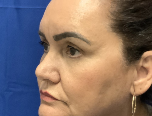 62 year old female 10 months after revision rhinoplasty after having it done years ago by another provider. Both septal and ear cartilage were used to provide structural support for her nose and improve her breathing.