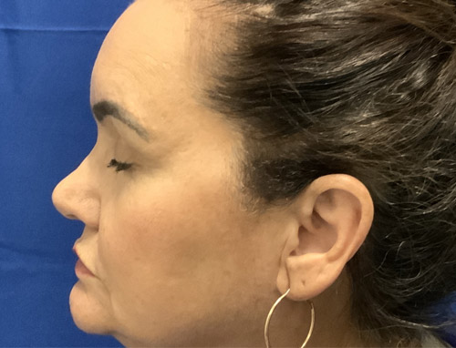 62 year old female 10 months after revision rhinoplasty after having it done years ago by another provider. Both septal and ear cartilage were used to provide structural support for her nose and improve her breathing.