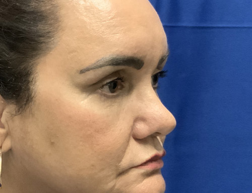 62 year old female 10 months after revision rhinoplasty after having it done years ago by another provider. Both septal and ear cartilage were used to provide structural support for her nose and improve her breathing.