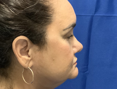 62 year old female 10 months after revision rhinoplasty after having it done years ago by another provider. Both septal and ear cartilage were used to provide structural support for her nose and improve her breathing.