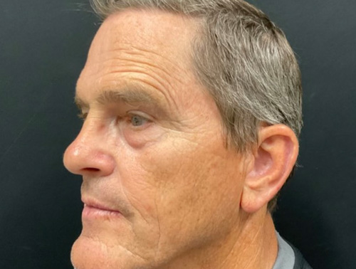 67 year old man shown 5 months after closed rhinoplasty.