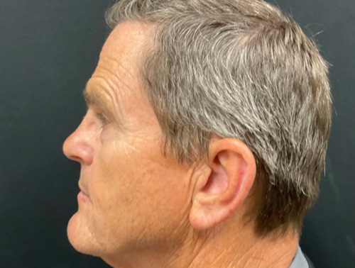 67 year old man shown 5 months after closed rhinoplasty.