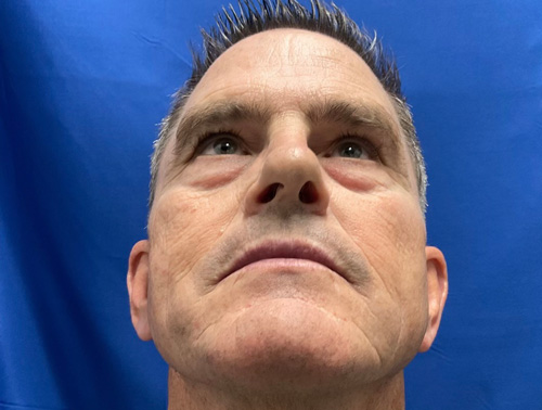 67 year old man shown 5 months after closed rhinoplasty.