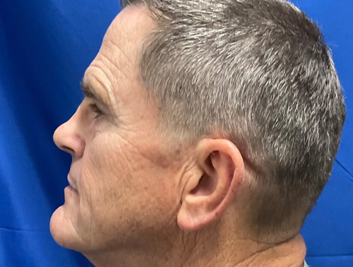67 year old man shown 5 months after closed rhinoplasty.