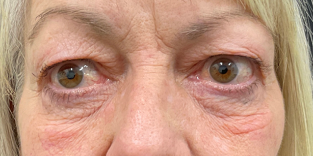 Thyroid Eye Disease After Front View Patient 2