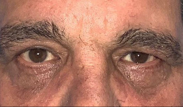 Upper eyelid surgery before and after patient front view