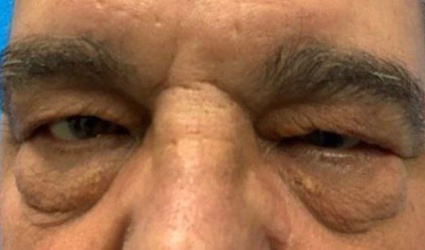 Upper eyelid surgery before and after patient front view