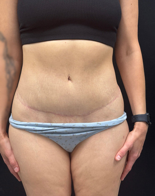 6 months abdominoplasty result.