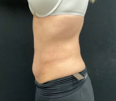 Mother in her early 40s is shown 6 months after a revisional “tummy tuck” procedure. Her original abdominoplasty was performed in another state.