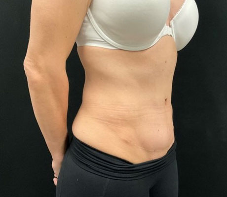 Mother in her early 40s is shown 6 months after a revisional “tummy tuck” procedure. Her original abdominoplasty was performed in another state.