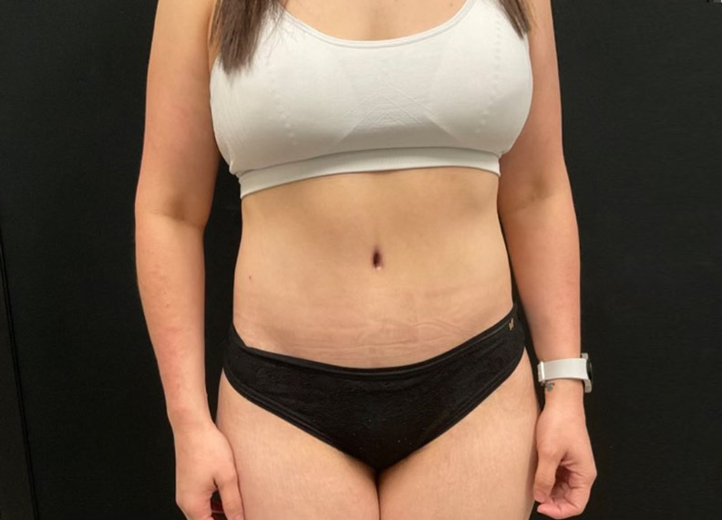 43 year old female shown 2 months after full abdominoplasty and liposuction of the flanks, lower back and upper abdomen