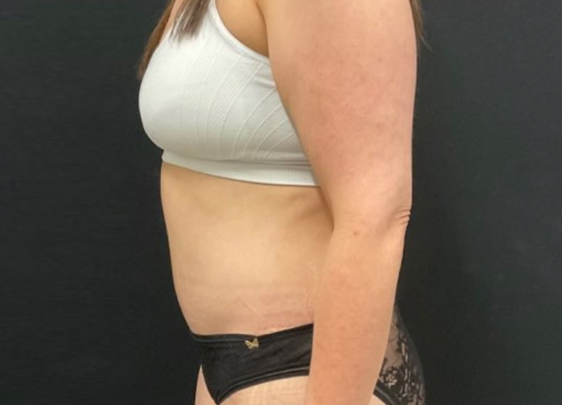 43 year old female shown 2 months after full abdominoplasty and liposuction of the flanks, lower back and upper abdomen