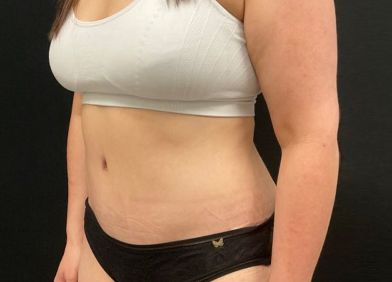 43 year old female shown 2 months after full abdominoplasty and liposuction of the flanks, lower back and upper abdomen