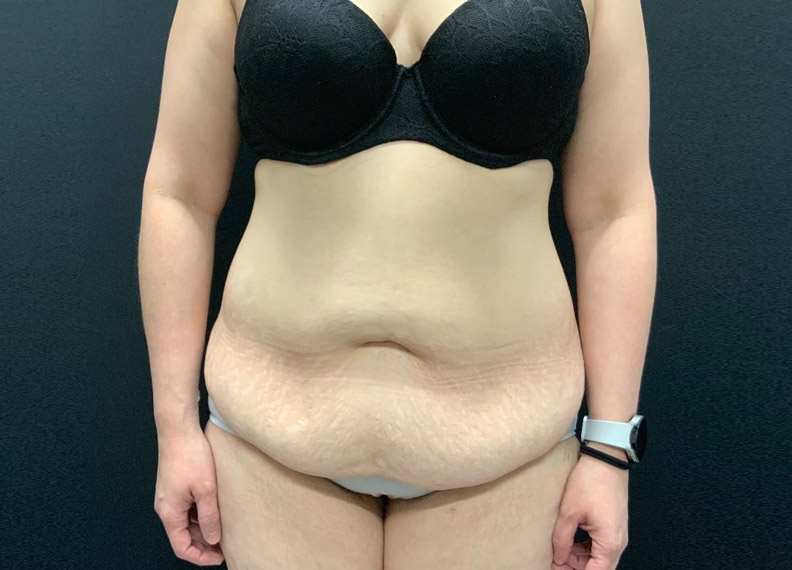 43 year old female shown 2 months after full abdominoplasty and liposuction of the flanks, lower back and upper abdomen