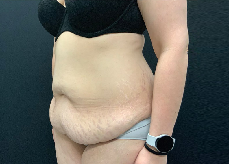 43 year old female shown 2 months after full abdominoplasty and liposuction of the flanks, lower back and upper abdomen