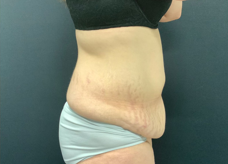 43 year old female shown 2 months after full abdominoplasty and liposuction of the flanks, lower back and upper abdomen