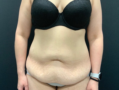 42 year old six weeks after abdominoplasty and liposuction