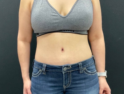 42 year old six weeks after abdominoplasty and liposuction