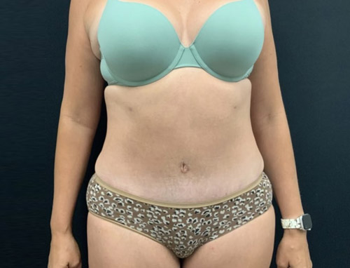 40 year old female 3.5 months after full abdominoplasty with liposuction of the upper abdomen and flanks.