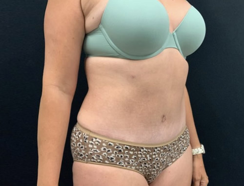 40 year old female 3.5 months after full abdominoplasty with liposuction of the upper abdomen and flanks.